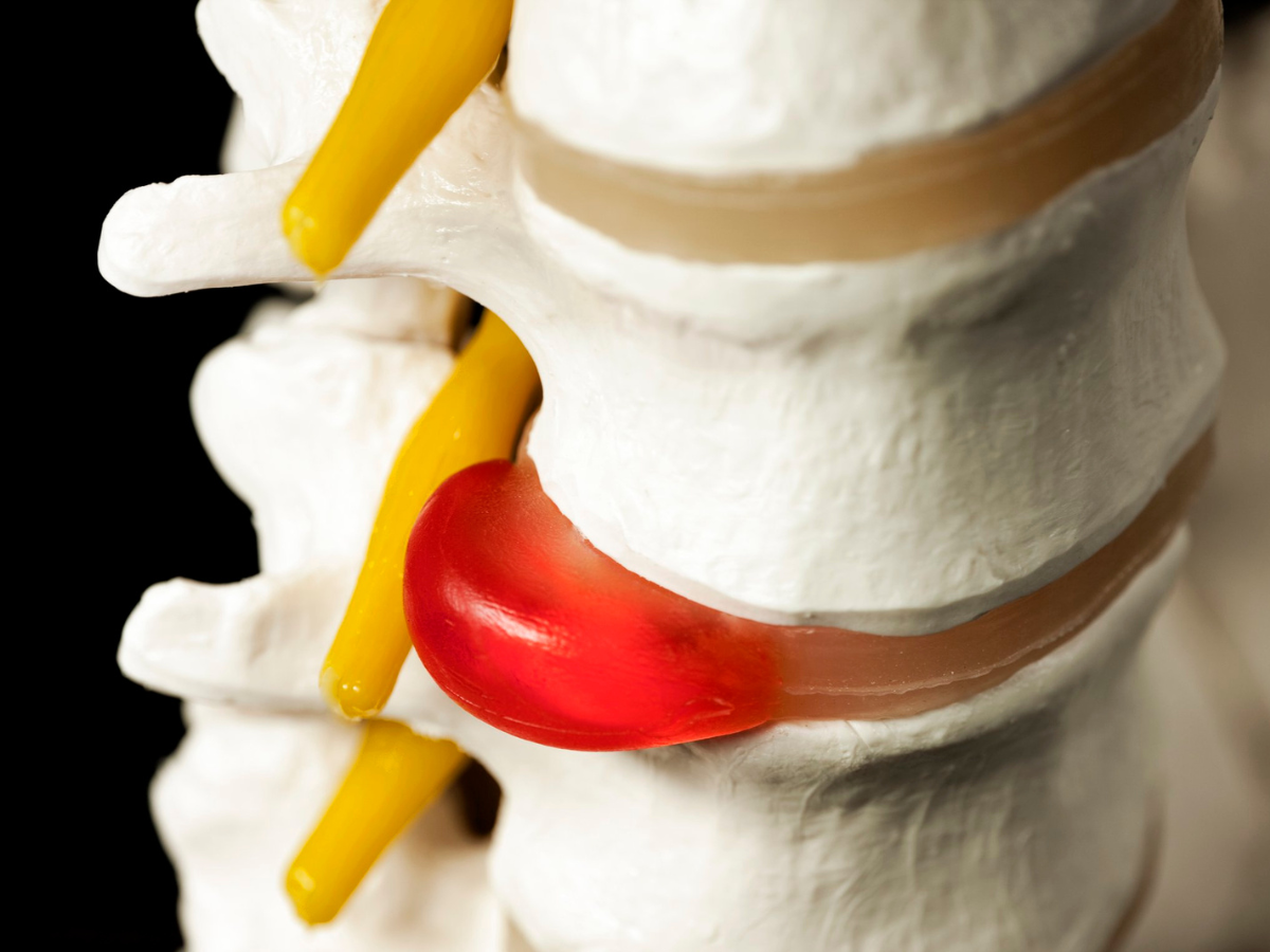 Hérnia de disco: o que é, sintomas e como tratar sem cirurgia